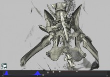 18 některé komplikované fraktury pro úspěšné vyřešení vyžadují předoperační 3D CT zobrazení