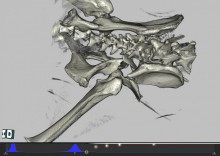 některé komplikované fraktury pro úspěšné vyřešení vyžadují předoperační 3D CT zobrazení
