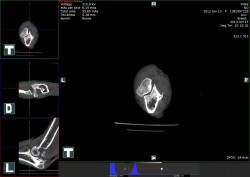 příčný CT sken v úrovni loketního kloubu