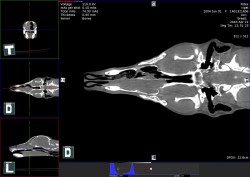 CT vyšetření nosní dutiny – rozsáhlý nádor – lymfom ,vyplňující nosní dutinu