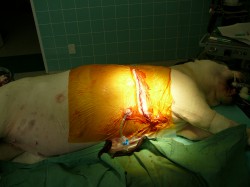 stav po operaci, zavedený nitrohrudní dren