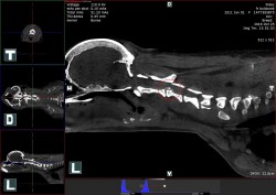 nativní CT vyšetření krční páteře – výhřez meziobratlové ploténky mezi C2 – C3