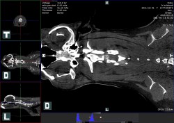 nativní CT vyšetření krční páteře – výhřez meziobratlové ploténky mezi C2 – C3