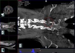 nativní CT vyšetření krční páteře –osteosarkom  6.krčního obratle
